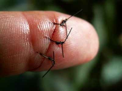 Finger kaputt.JPG